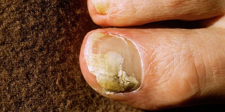 Effective home remedies for Toenail fungus